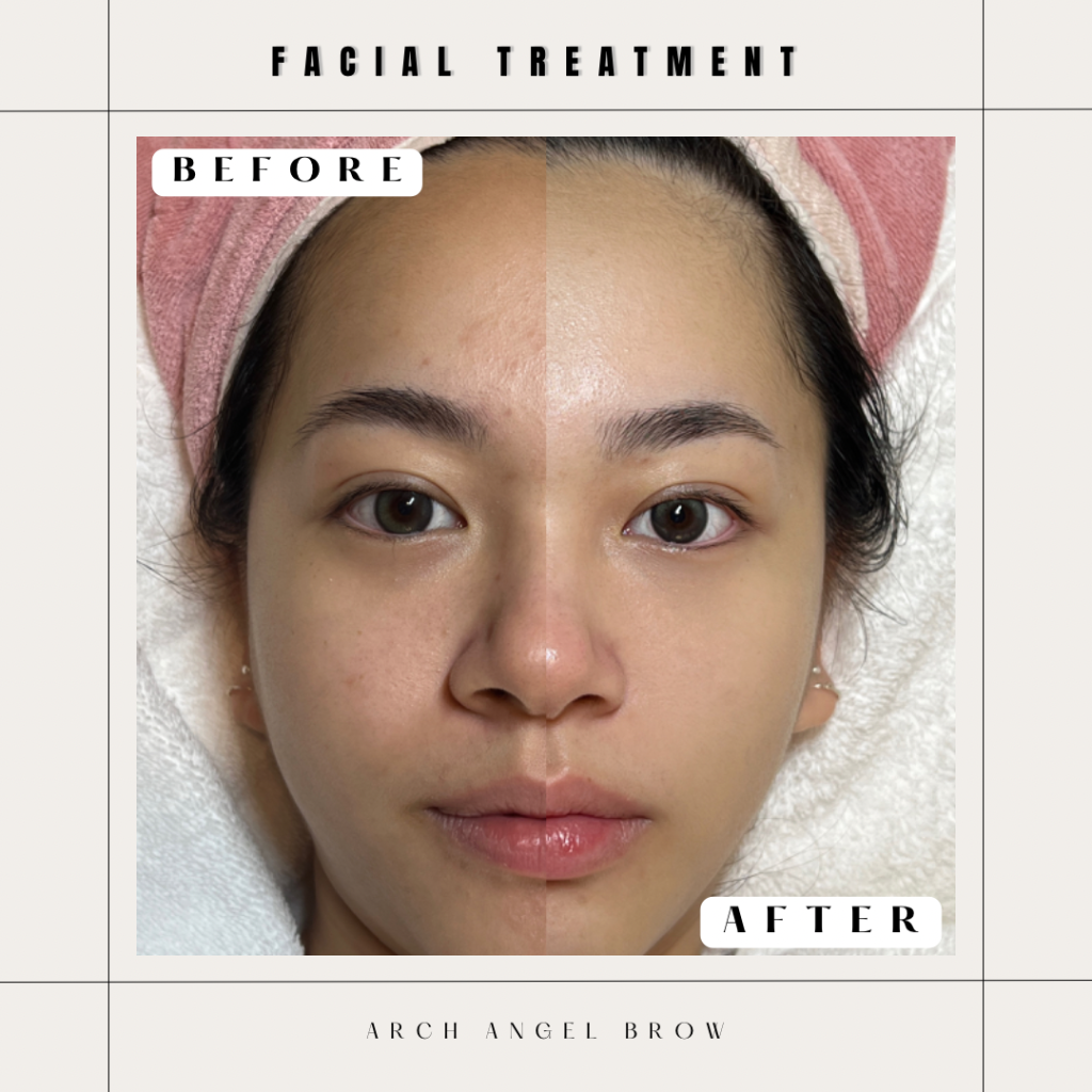 facial treatment